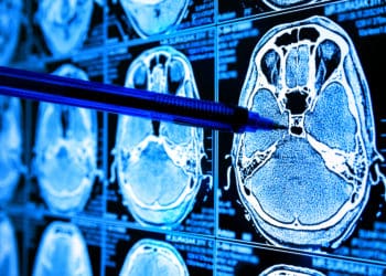 Brain scans are analyzed with the help of artificial intelligence in healthcare.