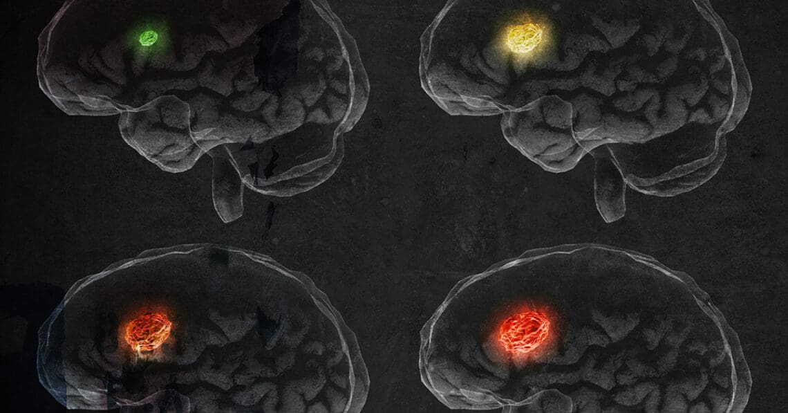 scan of different brain types