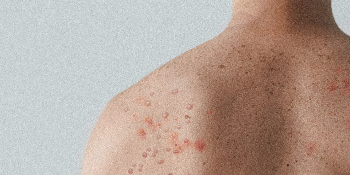 measles on man back