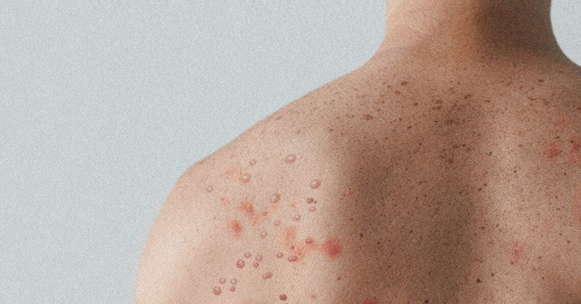 measles on man back