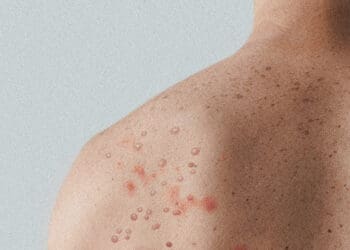 measles on man back