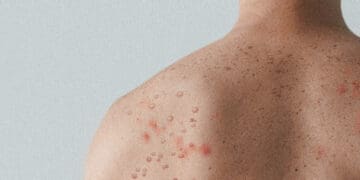 measles on man back