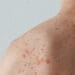 measles on man back